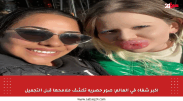 أكبر شفاه في العالم: صور حصرية تكشف ملامحها قبل التجميل